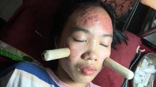 Introduction about inflammatory acne and how to solve it PART 1  official video  742019 [upl. by Naened999]