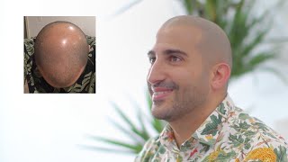 Scalp Micropigmentation Los Angeles CA  Scalp Micro USA [upl. by Sherurd898]