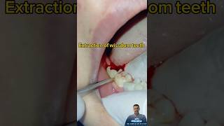 خلع ضرس العقل خلع الأسنان بدون ألم  extraction of wissdom teeth extractionteeth dentist [upl. by Atterol]