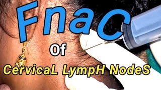 Fnac of Cervical Lymph Nodes ।। [upl. by Nodnnarb]