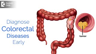 Early Detection of COLORECTAL DISEASES  Know the Importance  Dr Nanda Rajaneesh  Doctors Circle [upl. by Grimbal490]