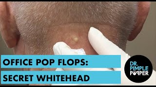 A Nice Whitehead on the Neck OFFICE POP FLOP [upl. by Yenaj317]