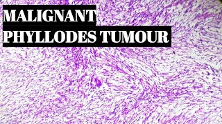 Malignant Phyllodes Tumour Histopathology [upl. by Arretnahs]