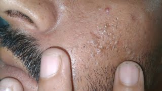 sac be spa blackheads elderly 2024  sac be spa old age blackheads 2024  sac be spa face scrub 4k [upl. by Nrubyar229]