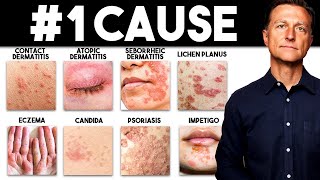 The MOST Common Deficiency in All Skin Diseases Dermatitis [upl. by Corly]