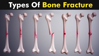 Common types of Bone fracture  3D animation [upl. by Niddala60]