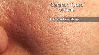 How to Treat Different Types of Acne [upl. by Yttocs]