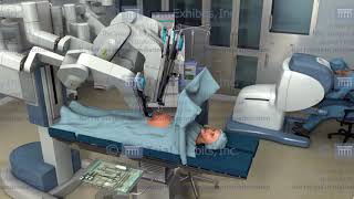 Medical Animations of Robotic Surgery [upl. by Harraf]