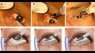 Probing and Dilators of surgical instruments [upl. by Ahael295]