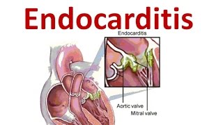 Endocarditis [upl. by Kissee]