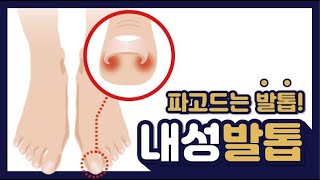 1분튼튼파고드는 발톱 통증 내성발톱 증상과 치료는 [upl. by Annayi]