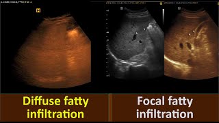 Fatty Liver Grade three  Diffuse Fatty infiltration  Focal fatty sparing [upl. by Ydnes]