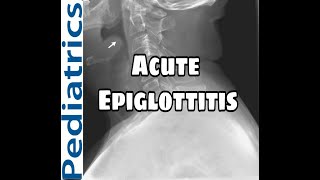 Acute Epiglottitis  Causes  Clinical features  Diagnosis and Treatment MED BABY In HINDI [upl. by Doowron]