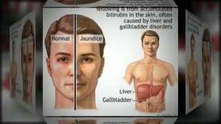 Cirrhosis Of The Liver Information [upl. by Akimal]