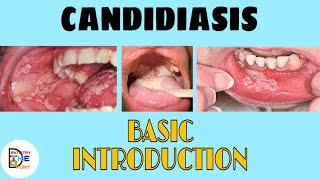 CANDIDIASIS  BASIC INTRODUCTION [upl. by Zacharia]