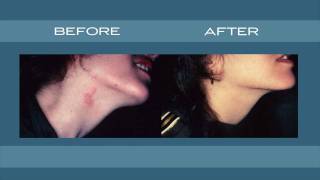 Skin Laser amp Surgery Specialists  Port Wine Stain Birthmark Removal  New York amp New Jersey [upl. by Tuchman]