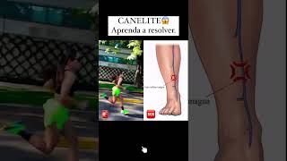 CANELITE😱Aprenda a resolver [upl. by Alrac]