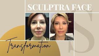 Sculptra Before amp After  My Review on the NonSurgical Facelift  Dominique Sachse [upl. by Yrrol]