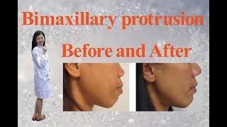 Bimaxillary protrusion before and after [upl. by Riancho99]