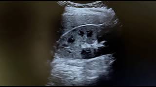 Ultrasound of acute pyelonephritis Read in description section n commrnt for detail history [upl. by Orlene]