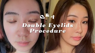 Nonincisional Double eye lids surgery 8 months Postrecovery QampA ft Allure Plastic Surgery [upl. by Maria]