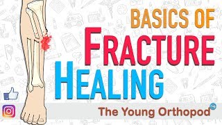 Fracture Healing  ANIMATION  BASICS  The Young Orthopod [upl. by Goerke169]