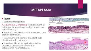 Disorders of growth and neoplasia  metaplasia dysplasia and carcinoma in situ [upl. by Basham]