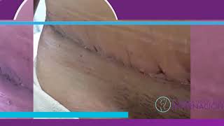 Abdominoplastia  Proceso de cicatrización [upl. by Ihp]