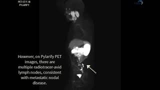 PSMA PETCT PYLARIFY Case 2 [upl. by Lillie]