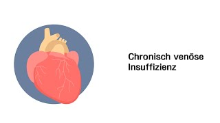 Chronisch venöse Insuffizienz CVI  Erkrankungen der Gefäße und des Kreislauf [upl. by Eilema]