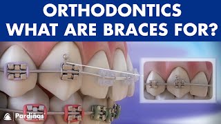 How Braces Work Elements of the orthodontic treatment and its role © [upl. by Aztilay]