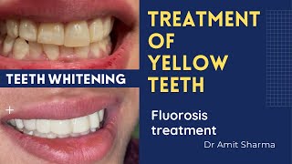 How dentist make yellow teeth white  Teeth whitening  Fluorosis treatment [upl. by Nirrol305]