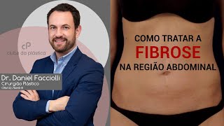 Clube da Plástica Como tratar a fibrose na região abdominal [upl. by Kristan]