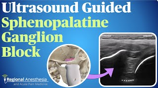 Ultrasound Guided Sphenopalatine Ganglion Block [upl. by Asirahc237]