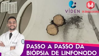 Como é feita a biopsia de linfonodo  processamento do material pelo laboratório [upl. by Enilreug]