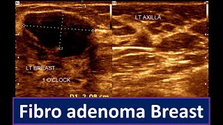 Fibroadenoma Breast Breast Lump  Brest ultrasonogram [upl. by Yrian]