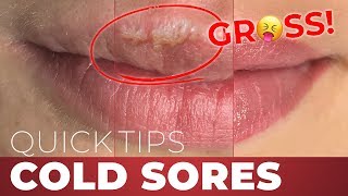 Negative Side Effects of Permanent Lip Makeup Cold Sores Quick Tips [upl. by Atram]