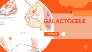 GALACTOCELECAUSES SYMPTOMS AND TREATMENTA MUST WATCH [upl. by Wyndham]