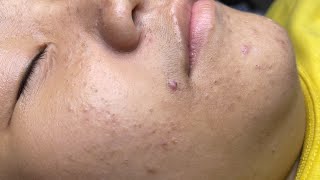 ACNE TREATMENT VU QUYNH MI Acne On Boys Cheek 2024 [upl. by Ahron]