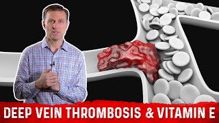 Deep Vein Thrombosis Blood Clots in Legs amp Vitamin E – Dr Berg [upl. by Hazem958]