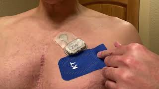 Zio Patch Heart Monitor Tricks [upl. by Sunny]