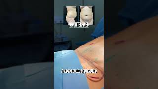 Abdominoplastie [upl. by Amiel]