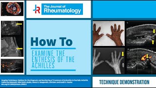 How to Examine the Enthesis of the Achilles [upl. by Inkster]