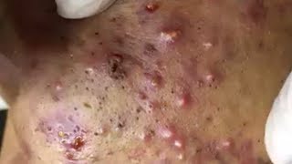 Inflammation Itching pustule and Toxic blood sucking of acne Part100 KD Acne Treatment [upl. by Aicena847]