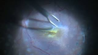 Epi Retinal gliosis Removal [upl. by Rezeile829]