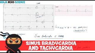 Rate and Rhythm  Sinus Bradycardia and Sinus Tachycardia [upl. by Garald113]