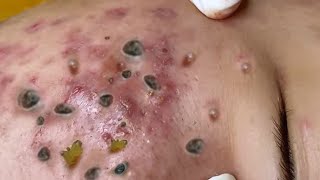 Big Cystic Acne Blackheads Extraction Blackheads amp Milia Whiteheads Removal Pimple Popping [upl. by Krahling722]