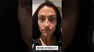 Before and After Septoplasty and Turbinate Reduction  2 Weeks Later [upl. by Notsnorb]