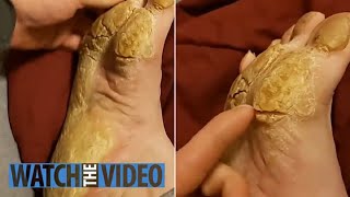 Removing Extremely Hard Foot Callus 🦶 The right way to remove foot callus FULL TREATMENT 06 [upl. by Emia]