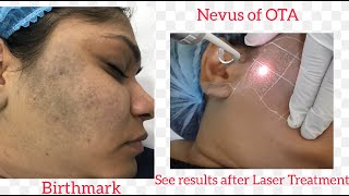 Nevus of OTA  Birth Mark  Laser Treatment  Dr Anuj Pall MD PhD FISD USA [upl. by Anelad364]